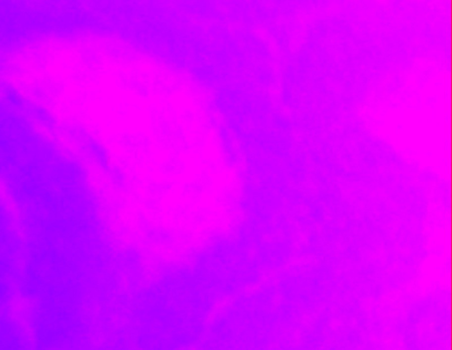 Hypoxic Tissue surrounding capillary is dark purplish blue stained with 